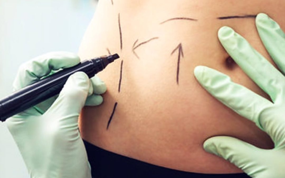 Drainage post-opératoire : bienfaits après liposuccion ou chirurgie esthétique
